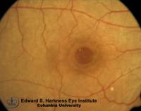 Fundus photograph of a macular hole with drusen-like yellow deposits and a cuff of subretinal fluid and the corresponding OCT study